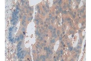 Detection of PKBg in Human Colorectal cancer Tissue using Polyclonal Antibody to Protein Kinase B Gamma (PKBg)