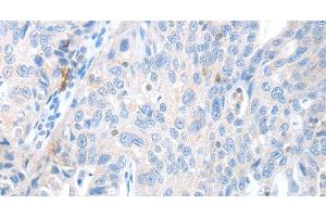 Immunohistochemistry of paraffin-embedded Human ovarian cancer using MAGEB4 Polyclonal Antibody at dilution of 1:40 (MAGEB4 anticorps)