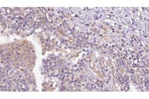 ABIN6273153 at 1/100 staining Human lymph cancer tissue by IHC-P. (RAP1B anticorps  (C-Term))