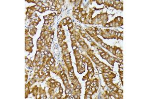 Immunohistochemistry of paraffin-embedded human thyroid cancer using COX15 antibody (ABIN7266634) at dilution of 1:100 (40x lens). (COX15 anticorps  (AA 150-250))