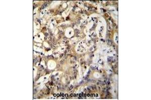 SP1 Antibody (C-term ) (ABIN655398 and ABIN2844945) immunohistochemistry analysis in formalin fixed and paraffin embedded human colon carcinoma followed by peroxidase conjugation of the secondary antibody and DAB staining.