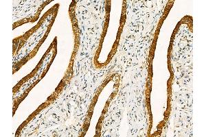 ABIN6261209 and ABIN6268652 at 1/100 staining Human ovarian cancer and adjacent normal tissues by IHC-P. (Cytokeratin 19 anticorps  (C-Term))