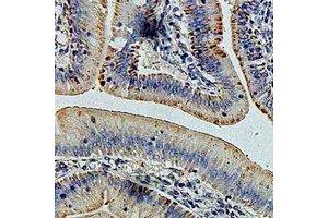 Immunohistochemical analysis of GLUD1 staining in human colon cancer formalin fixed paraffin embedded tissue section.