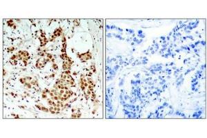 Immunohistochemical analysis of paraffin-embedded human breast carcinoma tissue using p90RSK(Phospho-Thr348) Antibody(left) or the same antibody preincubated with blocking peptide(right). (RPS6KA1 anticorps  (pThr348))