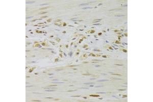 Immunohistochemistry of paraffin-embedded human gastric cancer using PRPF3 Antibody (ABIN5973192) at dilution of 1/100 (40x lens). (PRPF3 anticorps)