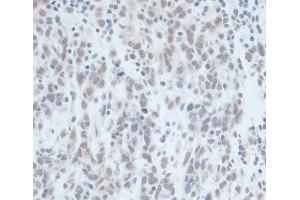 Immunohistochemistry of paraffin-embedded Human gastric cancer using ZNF703 Polyclonal Antibody at dilution of 1:100 (40x lens). (ZNF703 anticorps)