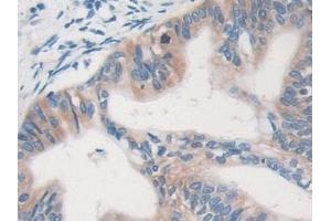 Detection of MVP in Human Pancreatic cancer Tissue using Polyclonal Antibody to Major Vault Protein (MVP)