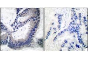 Immunohistochemistry analysis of paraffin-embedded human lung carcinoma tissue, using iNOS Antibody. (NOS2 anticorps  (AA 1101-1150))