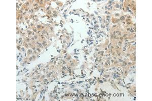 Immunohistochemistry of Human lung cancer using NDRG2 Polyclonal Antibody at dilution of 1:50 (NDRG2 anticorps)