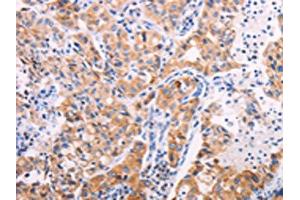 The image on the left is immunohistochemistry of paraffin-embedded Human lung cancer tissue using ABIN7131322(TEKT4 Antibody) at dilution 1/20, on the right is treated with fusion protein. (Tektin 4 anticorps)