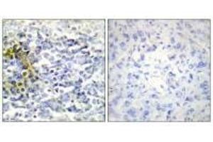 Immunohistochemistry analysis of paraffin-embedded human lung carcinoma tissue using FXR2 antibody. (FXR2 anticorps)