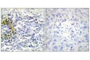 Immunohistochemistry analysis of paraffin-embedded human lung carcinoma tissue using FXR2 antibody.