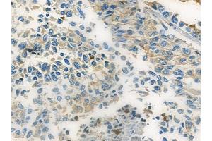 ABIN6257653 and ABIN6273822 at 1/100 staining human lung squamous cell carcinoma by IHC-P. (TRIB2 anticorps  (N-Term))