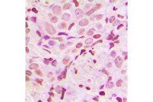 Immunohistochemical analysis of SRF (pS103) staining in human breast cancer formalin fixed paraffin embedded tissue section.