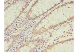 Immunohistochemistry of paraffin-embedded human colon cancer using ABIN7171437 at dilution of 1:100 (CCT6B anticorps  (AA 101-330))