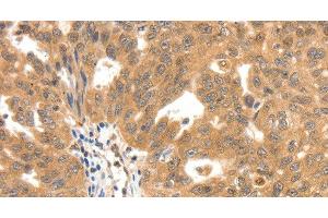 Immunohistochemistry of paraffin-embedded Human ovarian cancer tissue using SCN5A Polyclonal Antibody at dilution 1:30 (SCN5A anticorps)