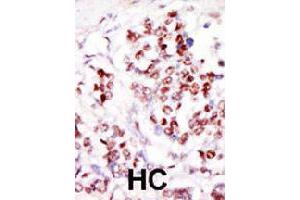 Formalin-fixed and paraffin-embedded human hepatocellular carcinoma tissue reacted with TLK1 polyclonal antibody  , which was peroxidase-conjugated to the secondary antibody, followed by DAB staining.