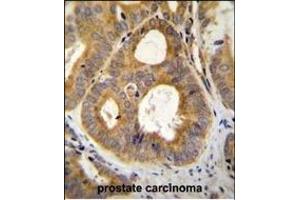 TR Antibody (N-term) (ABIN655614 and ABIN2845095) immunohistochemistry analysis in formalin fixed and paraffin embedded human prostate carcinoma followed by peroxidase conjugation of the secondary antibody and DAB staining.