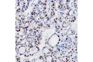 Immunohistochemistry of paraffin-embedded human thyroid cancer using EZH2/KMT6 Rabbit pAb (ABIN6133511, ABIN6140395, ABIN6140399 and ABIN6221414) at dilution of 1:100 (40x lens). (EZH2 anticorps  (AA 1-250))