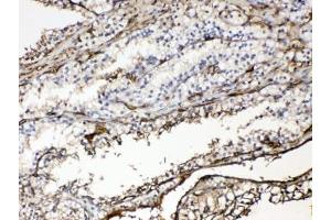 IHC testing of FFPE human renal cancer tissue with Hemoglobin antibody at 1ug/ml. (HBA1 anticorps)