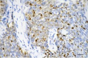 Immunohistochemistry was performed on paraffin-embedded human breast carcinoma using proliferating cell nuclear antigen antibody (ABIN7799914), 1:200). (PCNA anticorps)