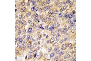 IHC analysis of FFPE human hepatocarcinoma tissue stained with GABARAP antibody (GABARAP anticorps  (AA 1-30))
