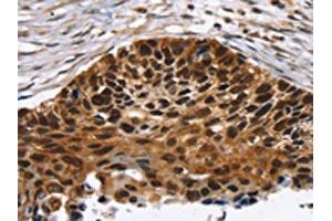 The image on the left is immunohistochemistry of paraffin-embedded Human esophagus cancer tissue using ABIN7192726(TACC2 Antibody) at dilution 1/30, on the right is treated with synthetic peptide. (TACC2 anticorps)