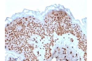 Formalin-fixed, paraffin-embedded human Basal Cell Carcinoma stained with Emerin Mouse Monoclonal Antibody (EMD/2167). (Emerin anticorps  (AA 56-167))