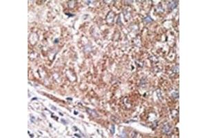 IHC analysis of FFPE human hepatocarcinoma tissue stained with the Nestin antibody
