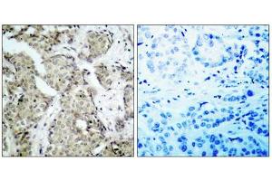 Immunohistochemical analysis of paraffin- embedded breast carcinoma, using MKK6 (Phospho- Ser207) Antibody.