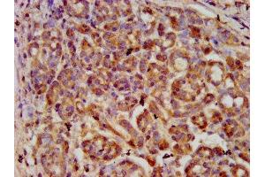 IHC image of ABIN7169341 diluted at 1:600 and staining in paraffin-embedded human pancreatic cancer performed on a Leica BondTM system.