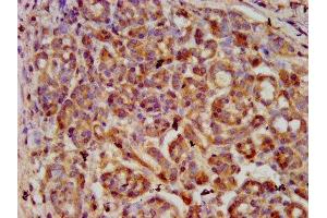 IHC image of ABIN7169341 diluted at 1:600 and staining in paraffin-embedded human pancreatic cancer performed on a Leica BondTM system. (SERPINB4 anticorps  (AA 128-208))