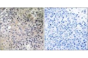 Immunohistochemistry analysis of paraffin-embedded human lung carcinoma tissue, using SHC3 Antibody. (SHC3 anticorps  (AA 291-340))