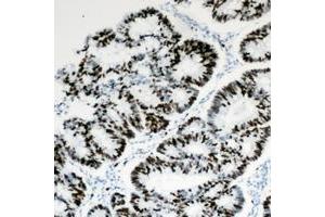 Immunohistochemical analysis of HBP1 staining in human colon cancer formalin fixed paraffin embedded tissue section.