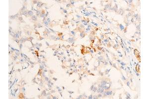 ABIN6267067 at 1/100 staining human lung cancer tissue sections by IHC-P.