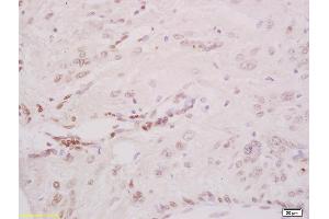 Formalin-fixed and paraffin embedded human cervical carcinoma labeled with Anti-Phospho-CHK2 (Thr68) Polyclonal Antibody, Unconjugated (ABIN703165) at 1:200 followed by conjugation to the secondary antibody and DAB staining (CHEK2 anticorps  (pThr68))
