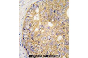 Formalin-fixed and paraffin-embedded human prostate carcinomareacted with GJB6 polyclonal antibody , which was peroxidase-conjugated to the secondary antibody, followed by AEC staining. (GJB6 anticorps  (N-Term))
