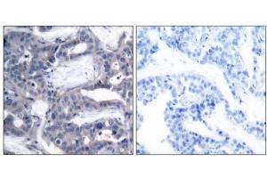 Immunohistochemical analysis of paraffin- embedded human breast carcinoma tissue using MEK2 (phospho-Thr394) antibody (E011008). (MEK2 anticorps  (pThr394))