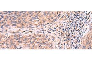 Immunohistochemistry of paraffin-embedded Human cervical cancer tissue using PER3 Polyclonal Antibody at dilution of 1:55(x200) (PER3 anticorps)