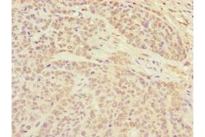 Immunohistochemistry of paraffin-embedded human ovarian cancer using ABIN7147357 at dilution of 1:100 (CETN3 anticorps  (AA 1-167))