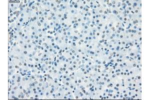 Immunohistochemical staining of paraffin-embedded Adenocarcinoma of breast tissue using anti-FCGR2A mouse monoclonal antibody. (FCGR2A anticorps)
