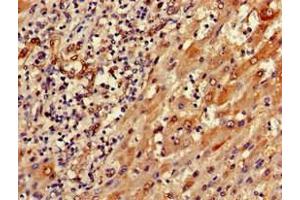 Immunohistochemistry of paraffin-embedded human liver cancer using ABIN7168819 at dilution of 1:100