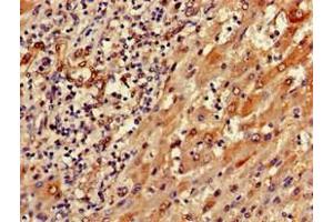 Immunohistochemistry of paraffin-embedded human liver cancer using ABIN7168819 at dilution of 1:100 (SEMA6A anticorps  (AA 755-990))