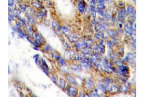 Immunohistochemical analysis of paraffin-embedded human colon cancer tissue using COL1A2 polyclonal antibody . (COL1A2 anticorps)