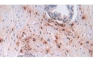 Detection of DEFa3 in Human Prostate Tissue using Polyclonal Antibody to Defensin Alpha 3, Neutrophil Specific (DEFa3) (DEFa3 anticorps  (AA 21-94))