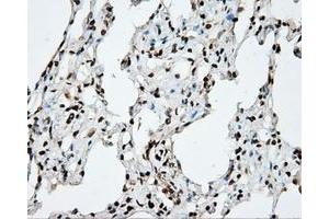 Immunohistochemical staining of paraffin-embedded Adenocarcinoma of ovary tissue using anti-DAPK2 mouse monoclonal antibody. (DAPK2 anticorps)