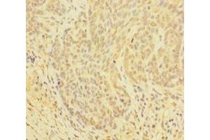 Immunohistochemistry of paraffin-embedded human ovarian cancer using ABIN7154046 at dilution of 1:100 (Glutaredoxin 1 anticorps  (AA 1-106))