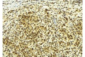 ABIN6278721 at 1/100 staining Human breast cancer tissue by IHC-P. (SUPT4H anticorps  (C-Term))