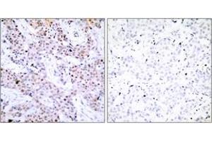 Immunohistochemistry analysis of paraffin-embedded human breast carcinoma tissue, using Estrogen Receptor-alpha (Ab-106) Antibody. (Estrogen Receptor alpha anticorps  (AA 71-120))