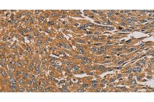 Immunohistochemistry of paraffin-embedded Human lung cancer tissue using PARP11 Polyclonal Antibody at dilution 1:30 (PARP11 anticorps)